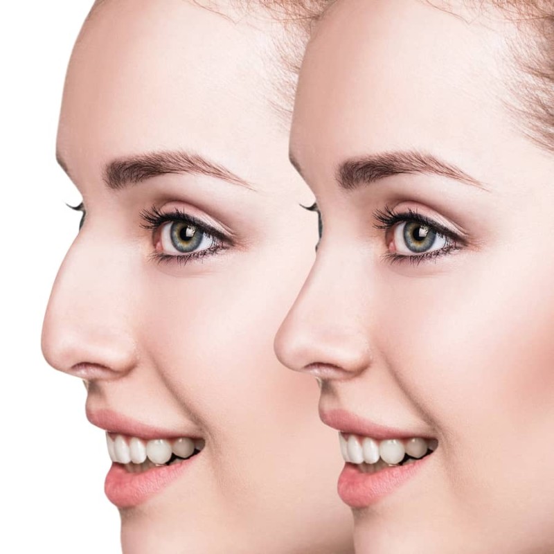 rhinoplasty miami