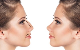 rhinoplasty