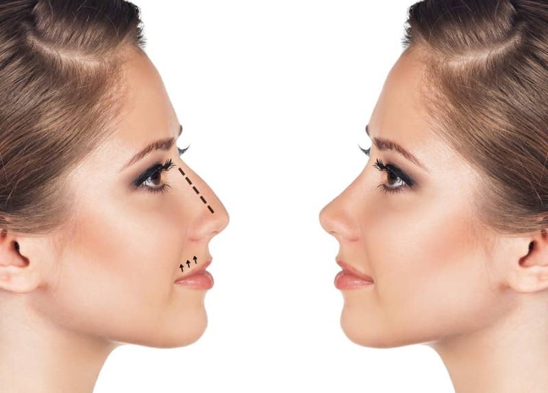 rhinoplasty