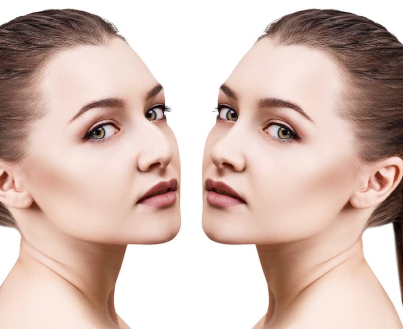 rhinoplasty procedure