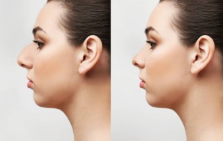 nose plastic surgery