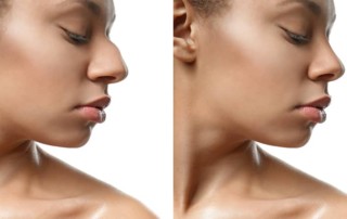 Revision Rhinoplasty Miami