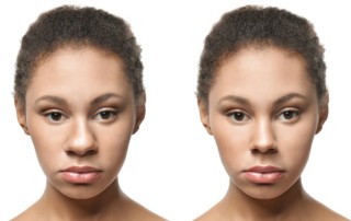 Rhinoplasty Surgery