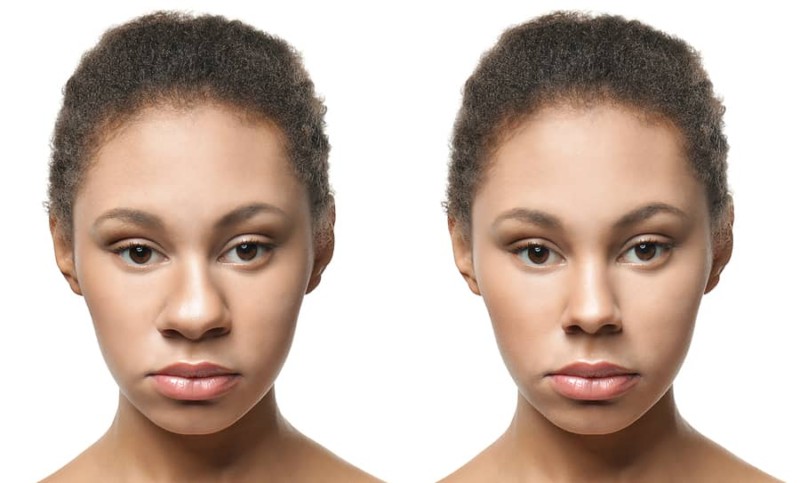 Rhinoplasty Surgery