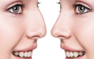 rhinoplasty surgery