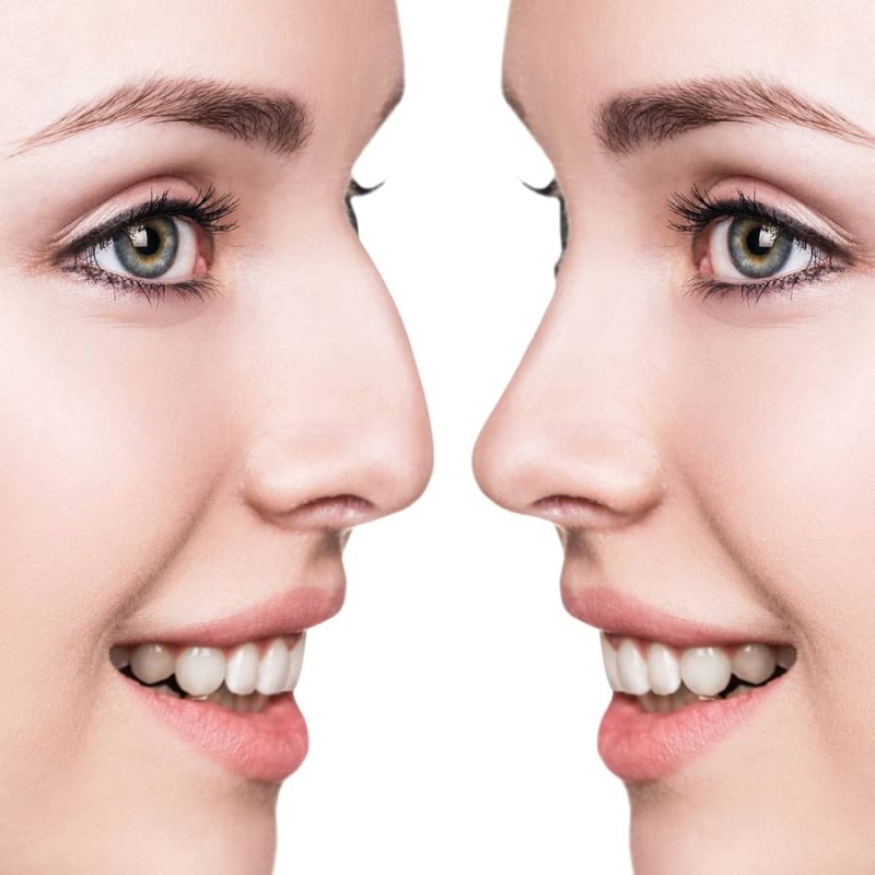 rhinoplasty surgery