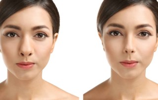 Miami Rhinoplasty