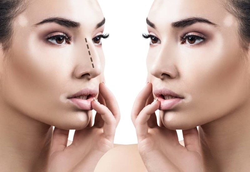 Miami Rhinoplasty