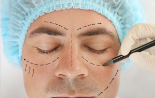 Male Rhinoplasty