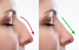 rhinoplasty