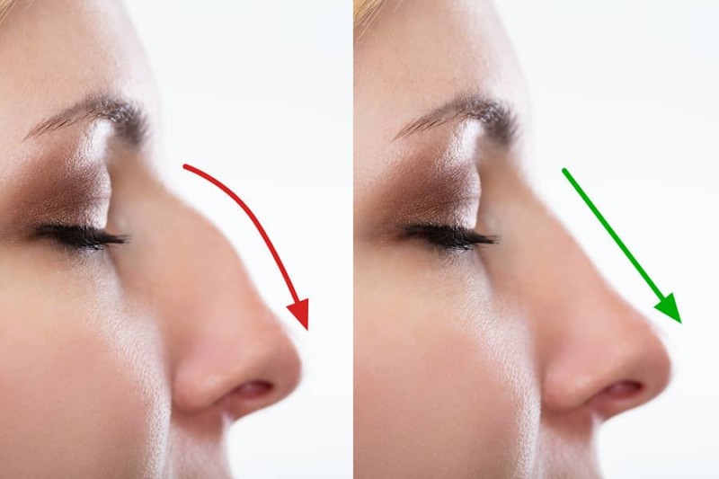 rhinoplasty